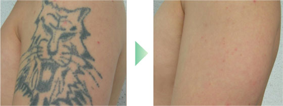 ピコレーザーの症例