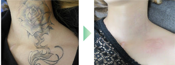 ピコレーザーの症例